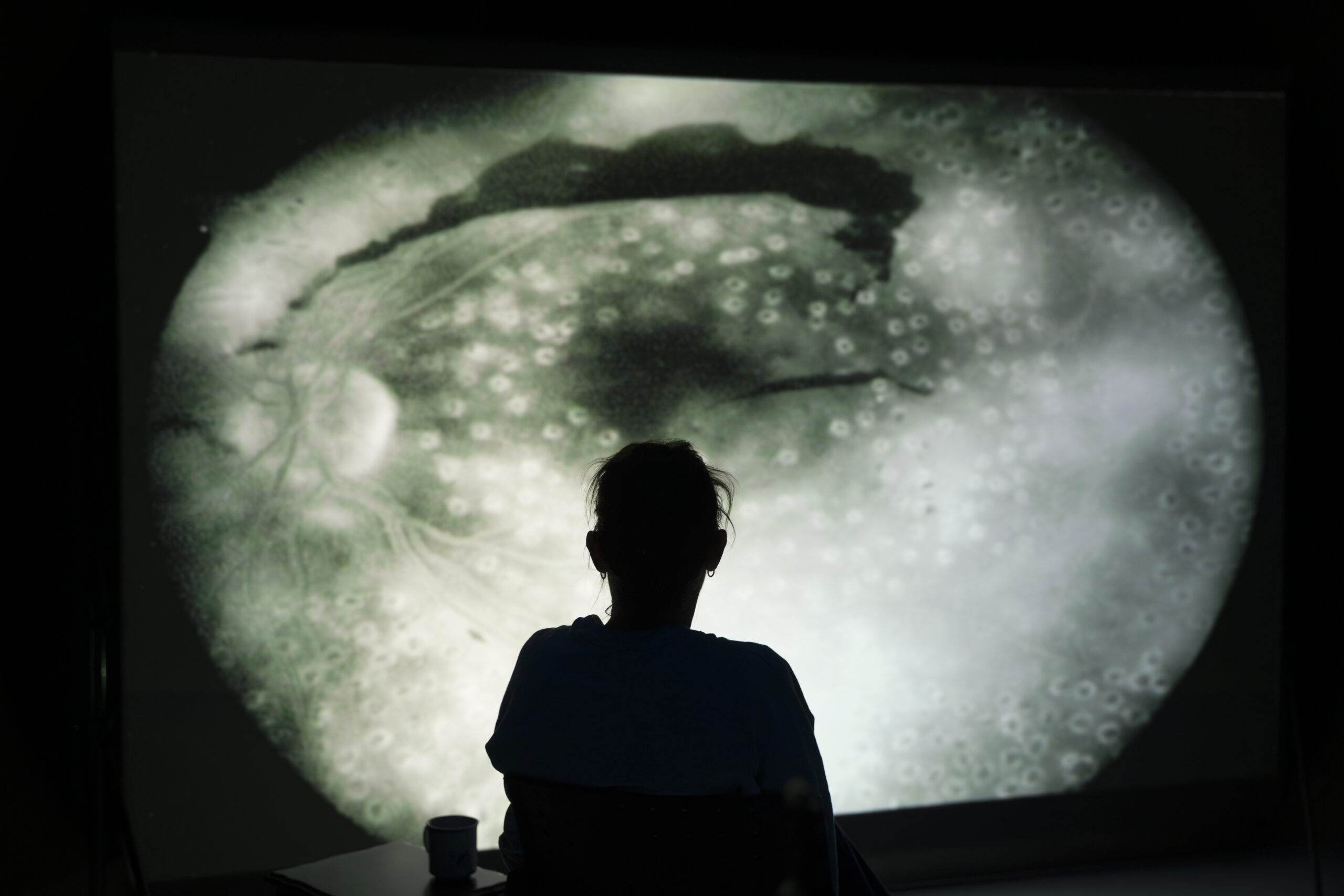 A silhouette of a person looking at a projector screen, which displays a medical photo of an eye